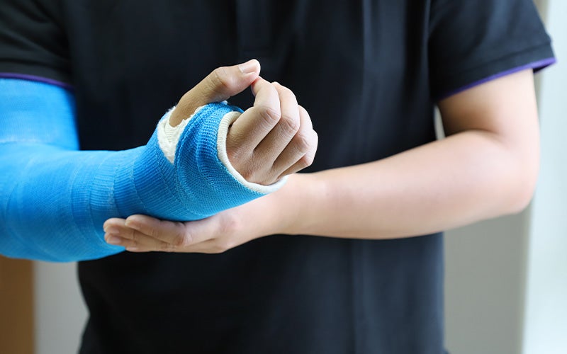 Close-up of a person wearing a vibrant blue arm cast, holding the casted arm with their other hand.