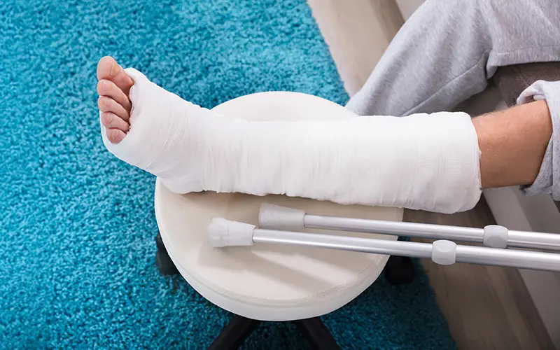A person with a white cast on their lower leg and foot, resting it on a stool next to crutches.